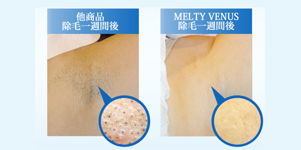 MELTY VENUSは、除毛後、新しいムダ毛の発毛を抑えます。公式の検証画像